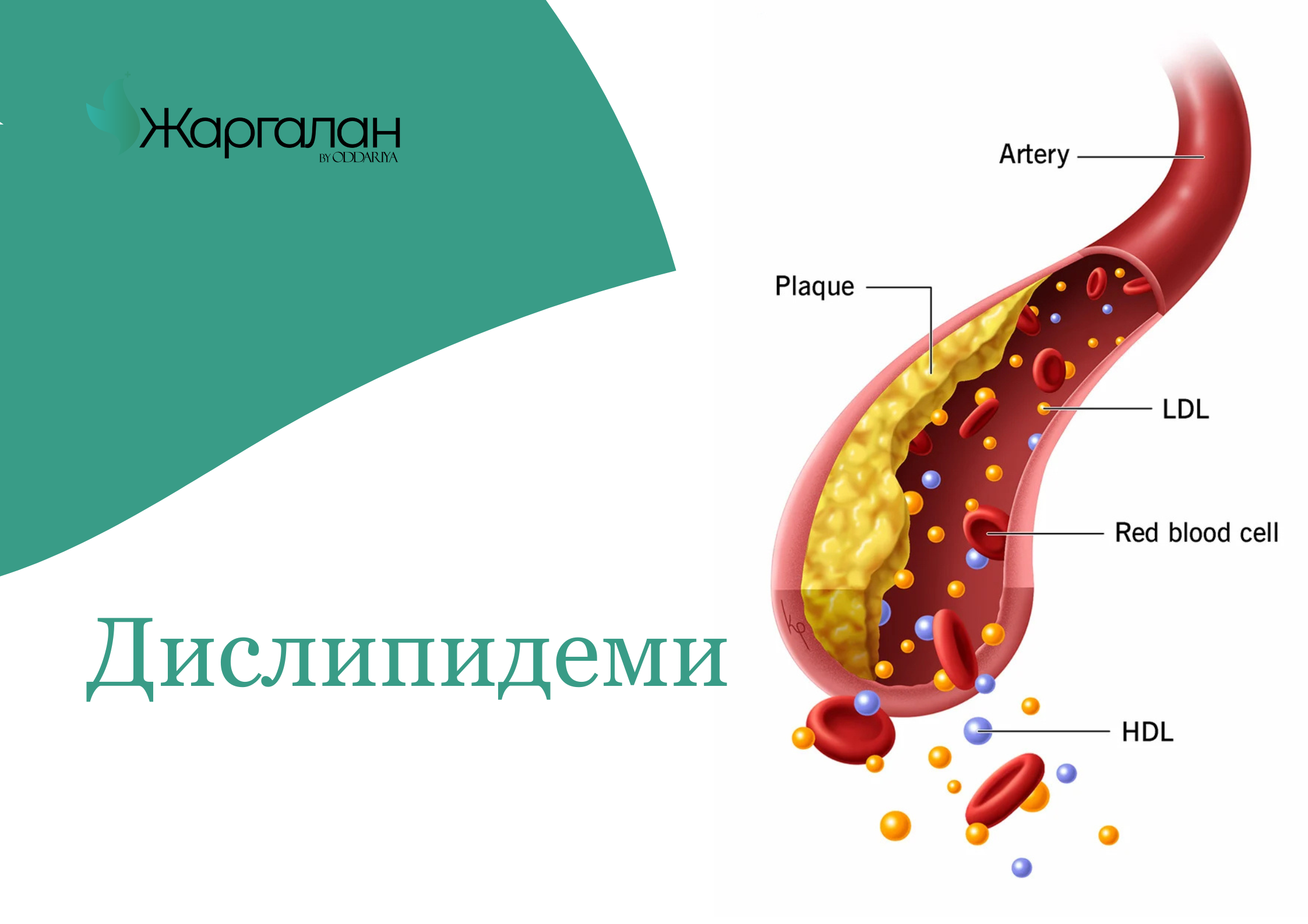 Насанд хүрэгчдийн дислипидемийн оношилгоо, эмчилгээний менежмент цогц сургалт